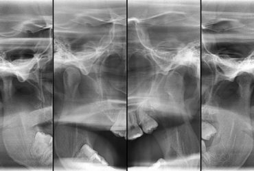 Radiografia de ATM