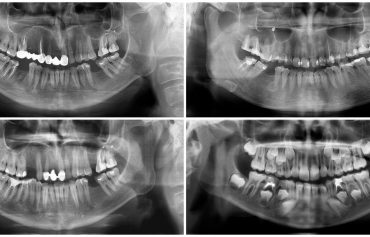 Radiografia Periapical