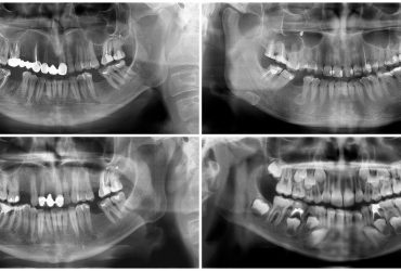 Radiografia Periapical