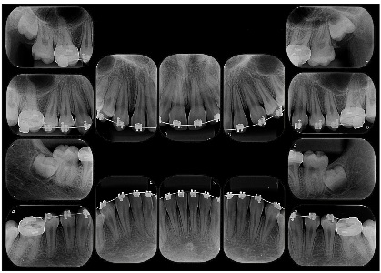 Radiografia Periapical – CROC DIGITAL