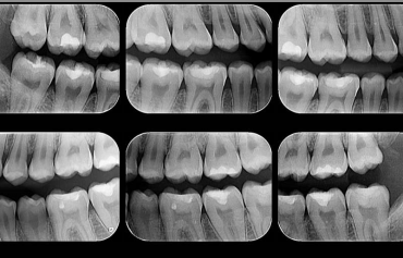 Radiografia Interproximal