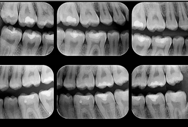 Radiografia Interproximal