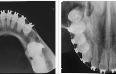 Radiografia Oclusal