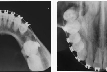 Radiografia Oclusal